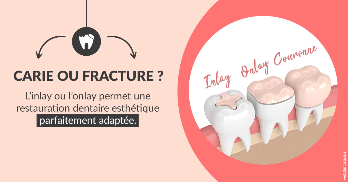 https://dr-barthelet-romain.chirurgiens-dentistes.fr/T2 2023 - Carie ou fracture 2