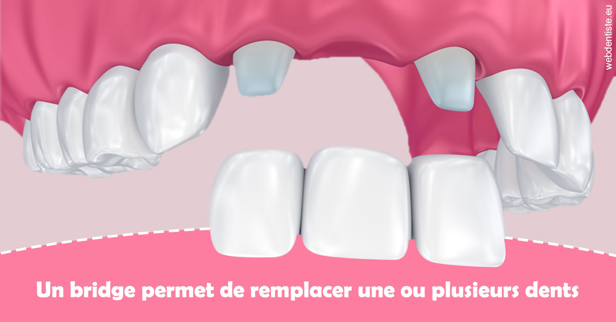 https://dr-barthelet-romain.chirurgiens-dentistes.fr/Bridge remplacer dents 2