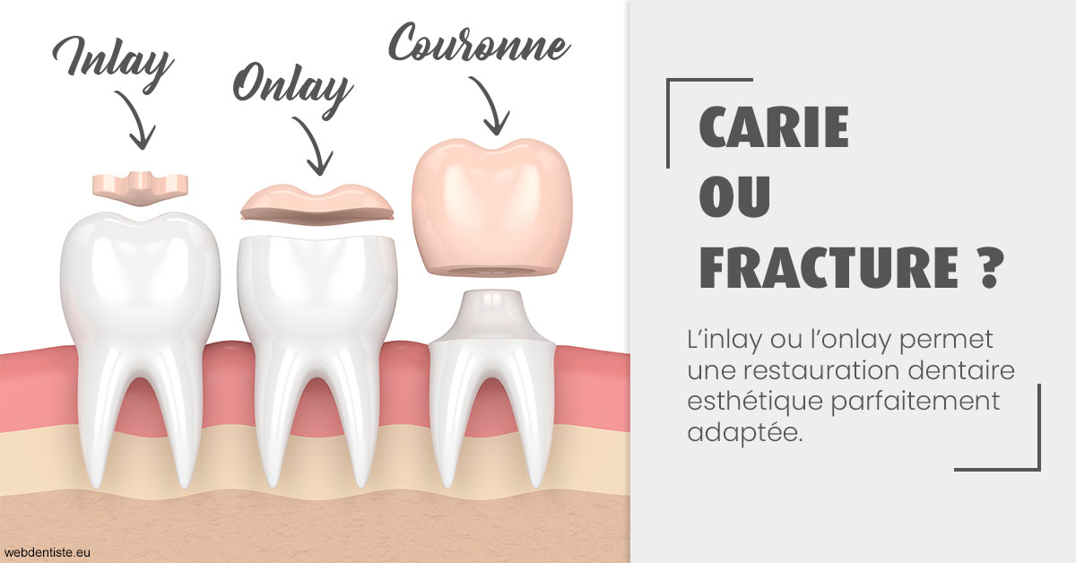 https://dr-barthelet-romain.chirurgiens-dentistes.fr/T2 2023 - Carie ou fracture 1