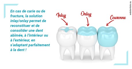 https://dr-barthelet-romain.chirurgiens-dentistes.fr/L'INLAY ou l'ONLAY