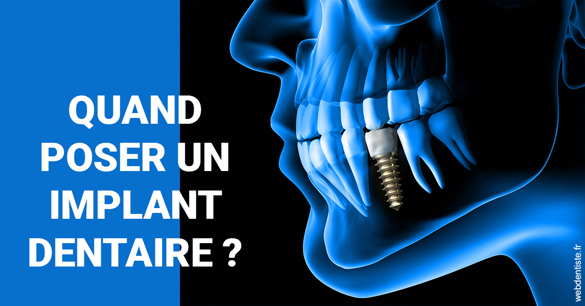https://dr-barthelet-romain.chirurgiens-dentistes.fr/Les implants 1