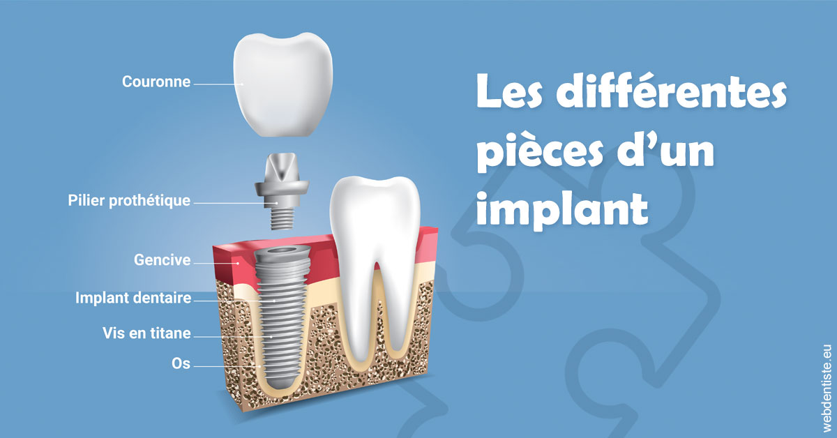 https://dr-barthelet-romain.chirurgiens-dentistes.fr/Les différentes pièces d’un implant 1